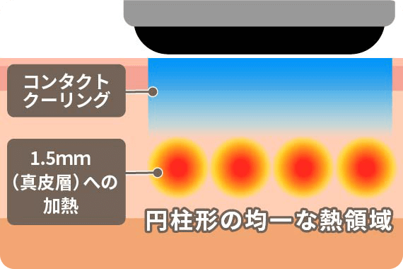 ソフウェーブ（Sofwave）の治療内容