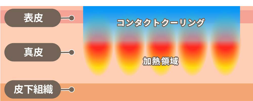 高周波超音波（SUPERB™）の効果