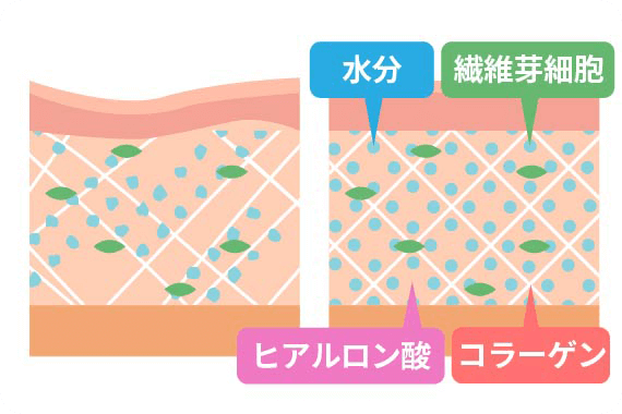 ソフウェーブ治療の効果の現れ方の図