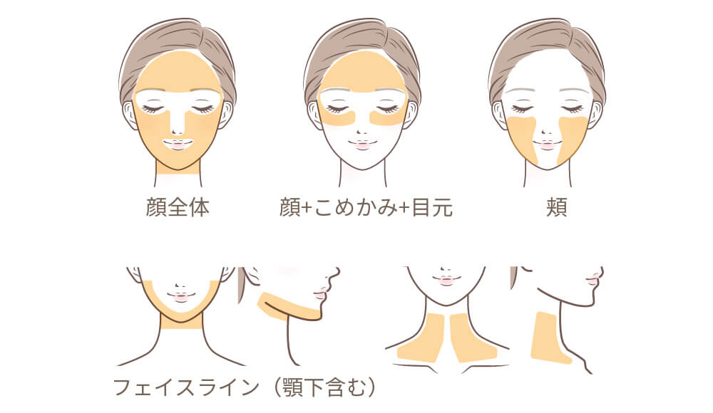 ソフウェーブの照射範囲の画像